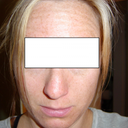 Before restylane